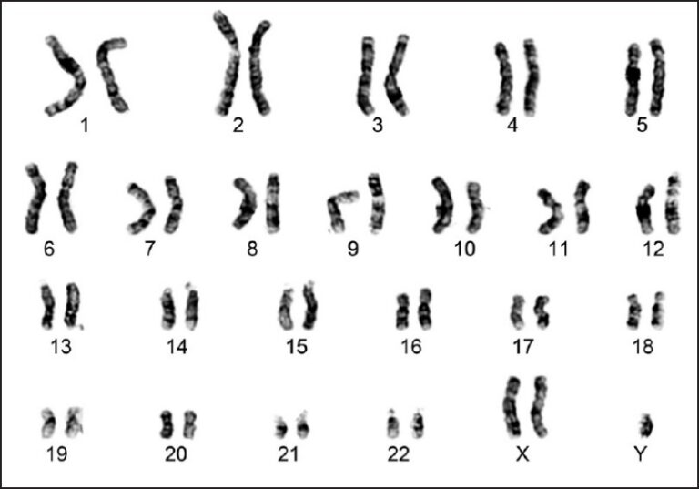 Sindrome di Klinefelter